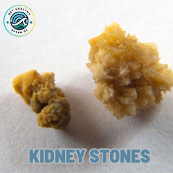 Kidney stones. ow long can back pain last